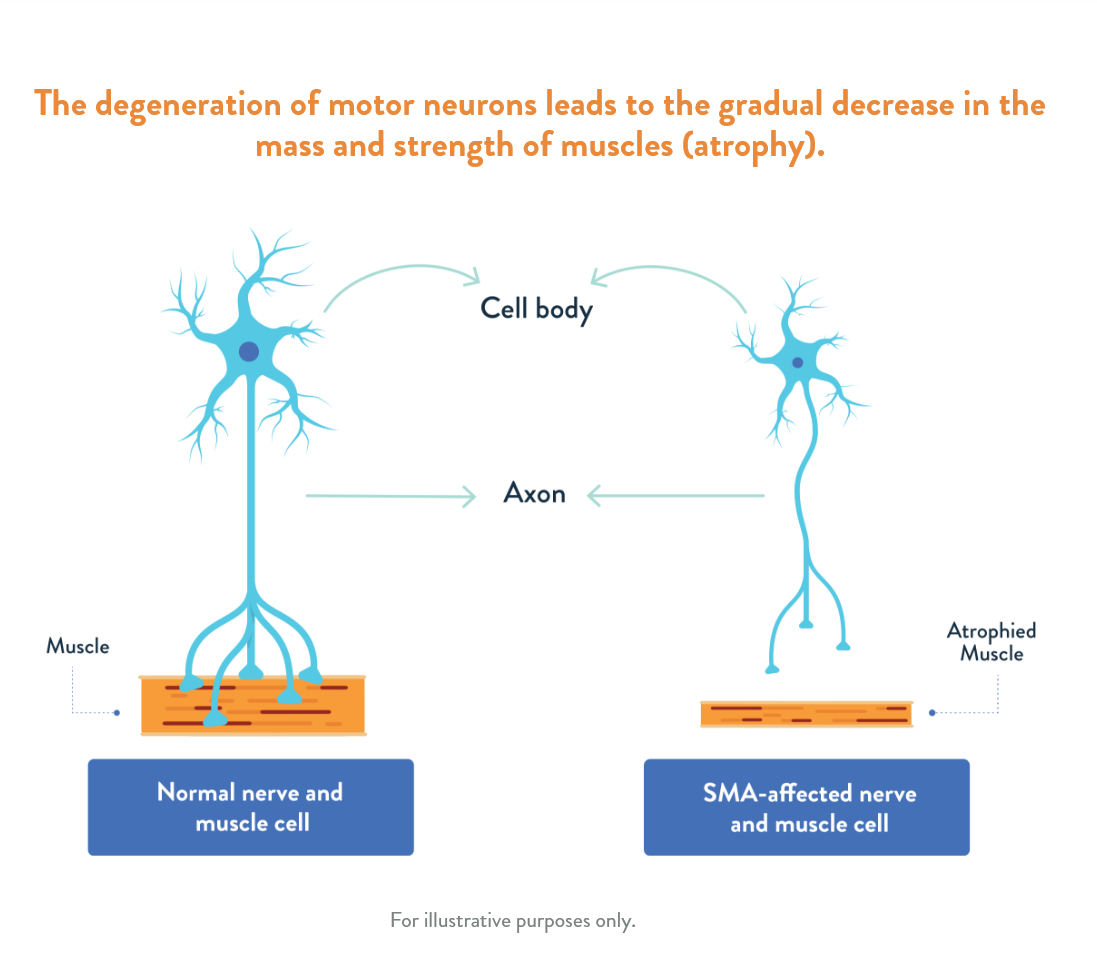 What causes SMA schema
